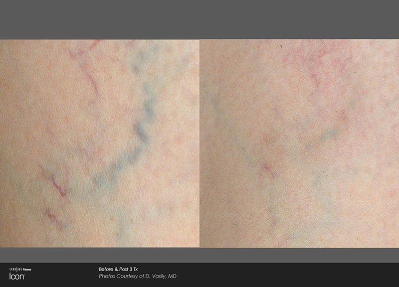 Middlesex County Laser Vein Removal