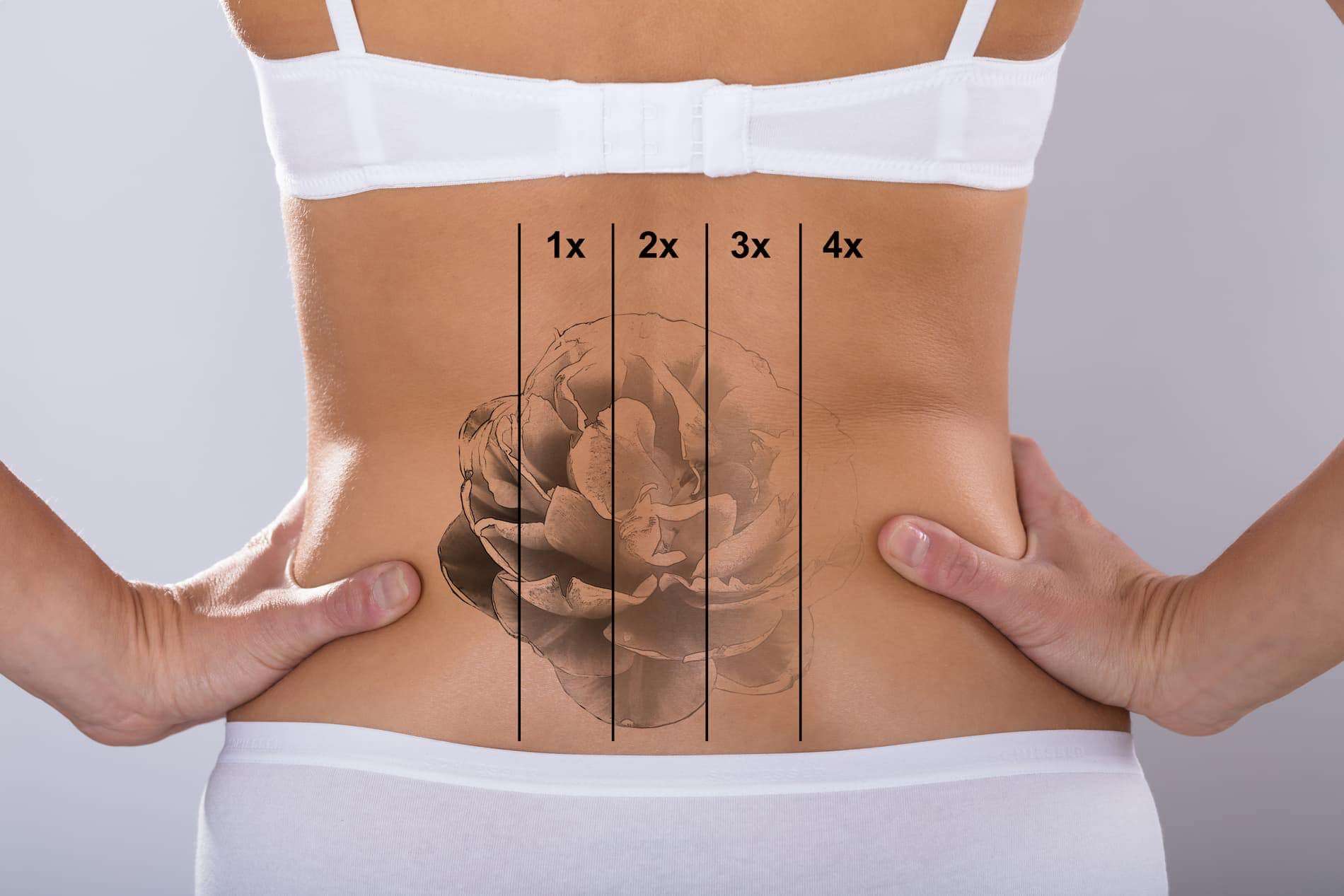 Tattoo Removal Middlesex County NJ