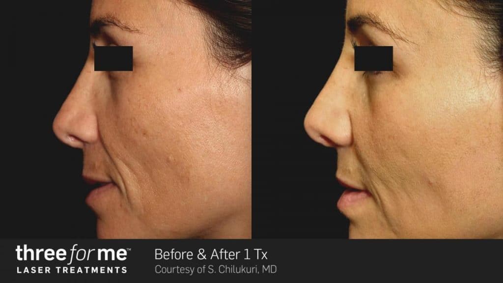 Side-by-side comparison of a woman's face in profile, showing before and after effects of a laser treatment. The "after" image reveals smoother skin texture with reduced wrinkles, blemishes, and acne scars. Text reads "three for me laser treatments.